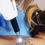 eliminar tatuajes con laser